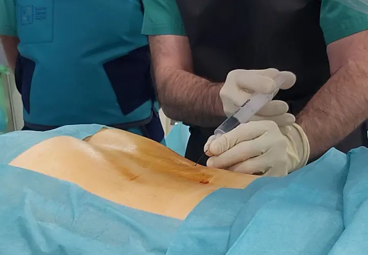 Procedimiento médico de ozonoterapia para tratar una hernia discal. Un profesional sanitario administra una inyección en la zona lumbar.