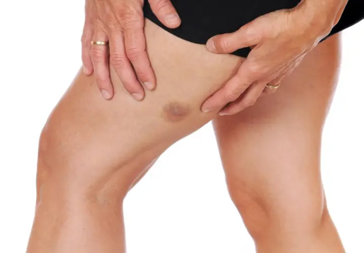 Un hematoma en el muslo, visible bajo la piel, con manos que lo sujetan suavemente.
