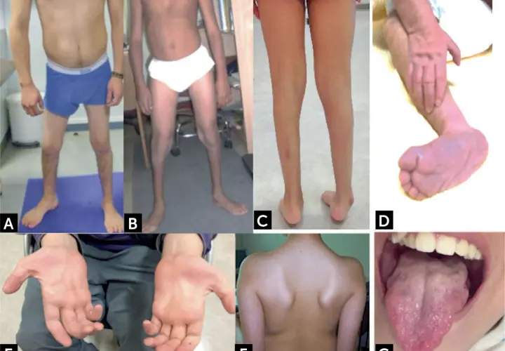 Manifestaciones de atrofia muscular espinal: piernas delgadas (A, B, C), pie equino (D), manos con dedos finos (E), espalda con escápulas prominentes (F) y lengua con fasciculaciones (G).