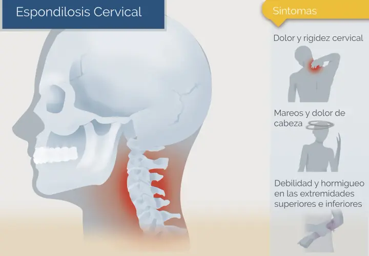 Ilustración de la columna cervical con zonas de dolor, junto a iconos de síntomas.