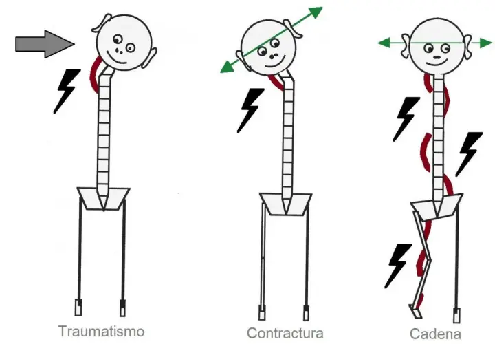Ilustración muestra cómo un traumatismo, contractura o una cadena de tensiones musculares afectan la postura y el cuerpo.