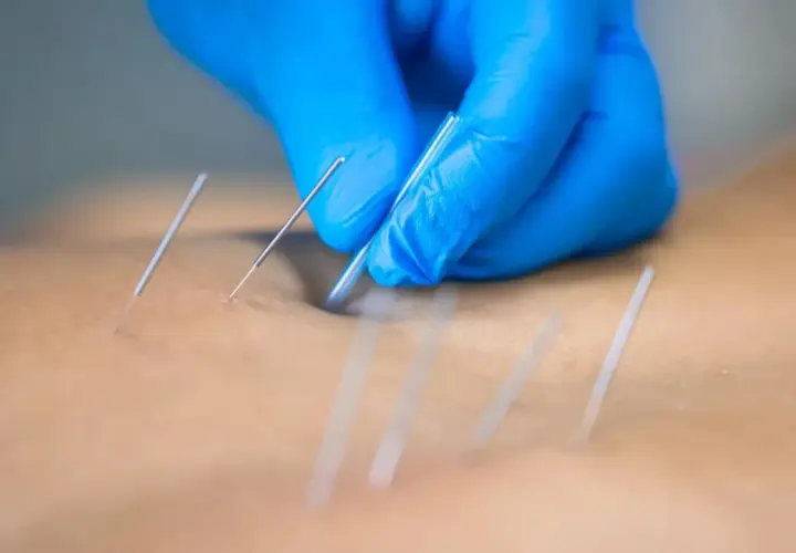 Manos enguantadas aplican agujas para punción seca, aliviando una contractura muscular.