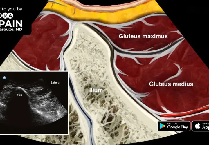 Anatomía de la pelvis y glúteos, mostrando el ilion, glúteo mayor y medio. Ecografía de la zona del PSIS y sacro, útil para diagnosticar el síndrome piriforme.