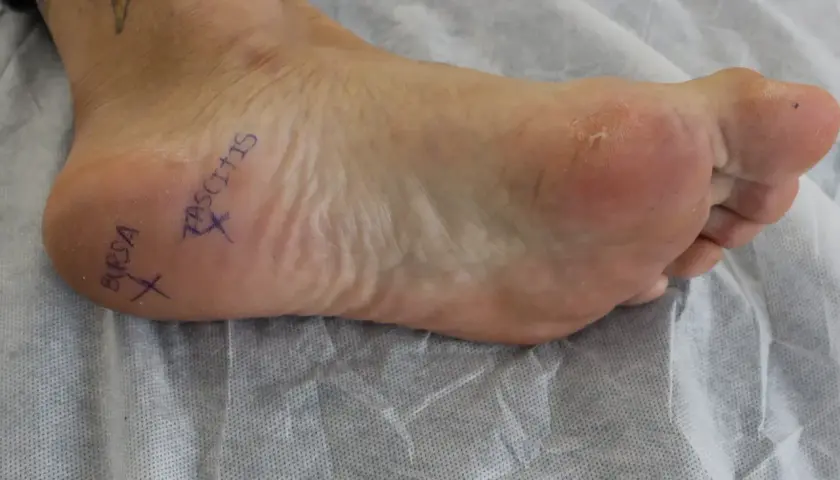Marcado en el pie, "BURSA" y "FASCITIS" indican áreas de dolor, sugiriendo bursitis y fascitis plantar.