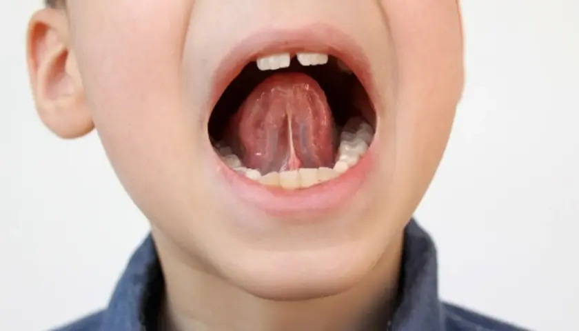 Boca abierta de un niño mostrando la lengua y el frenillo.