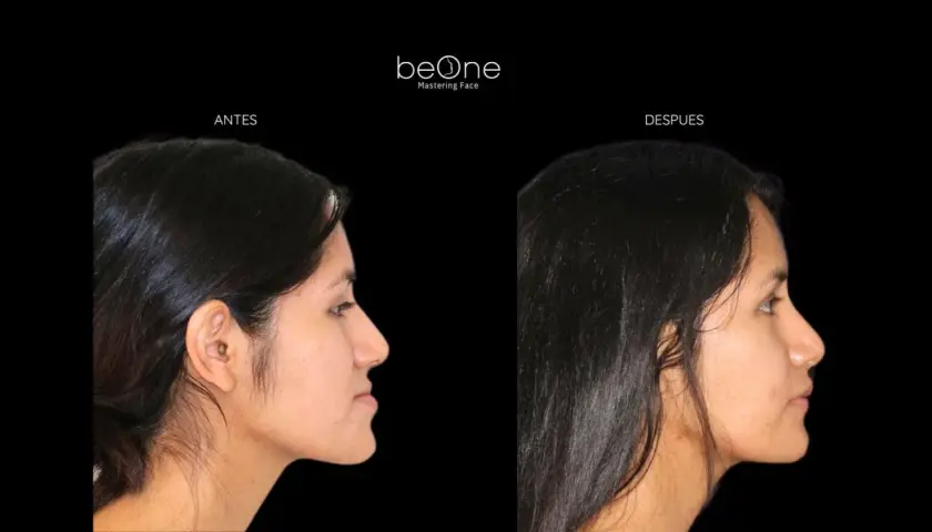Perfil de mujer antes y después de una operación de mandíbula. La imagen muestra un cambio notable en la proyección facial.