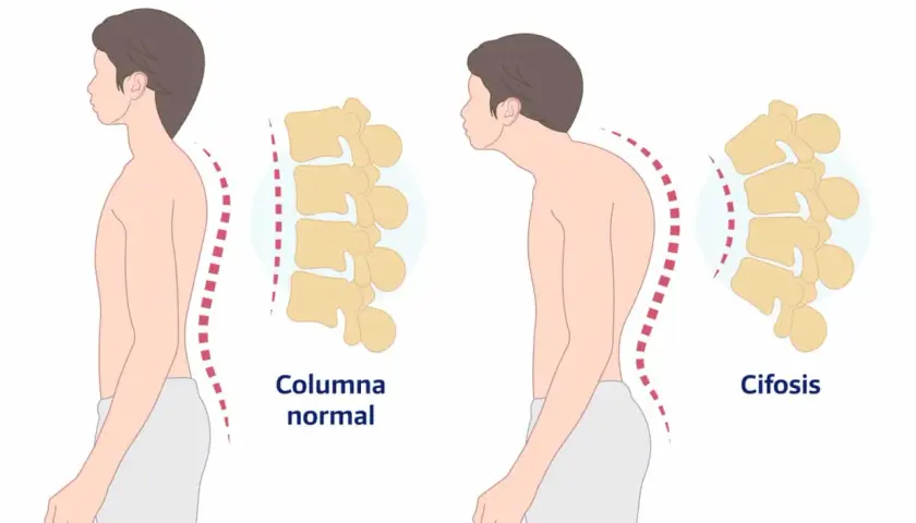Comparación de columna normal y cifosis dorsal. La imagen muestra la curvatura de la espalda y la columna vertebral en dos posturas.