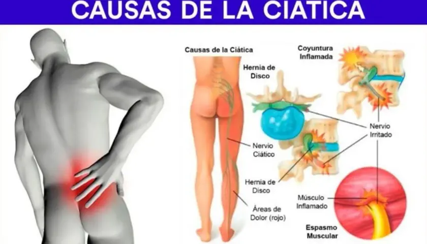Ilustración muestra las causas de la ciática: hernia de disco, nervio ciático irritado y espasmo muscular, explicando los síntomas.