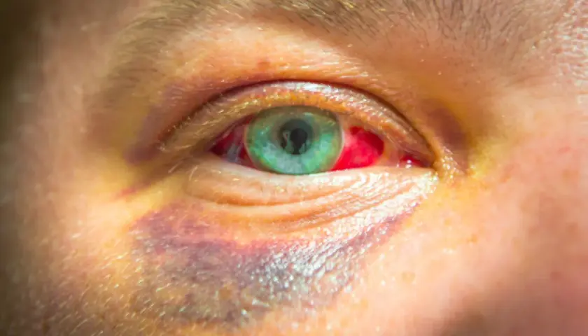 Ojo morado por golpe, con la esclerótica enrojecida. Buscando un remedio casero para aliviar la inflamación y el dolor.