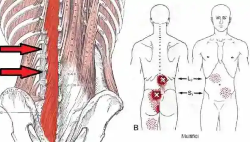 Anatomía de la espalda con flechas rojas señalando la zona afectada por un posible desgarro muscular espalda. Puntos rojos indican dolor.