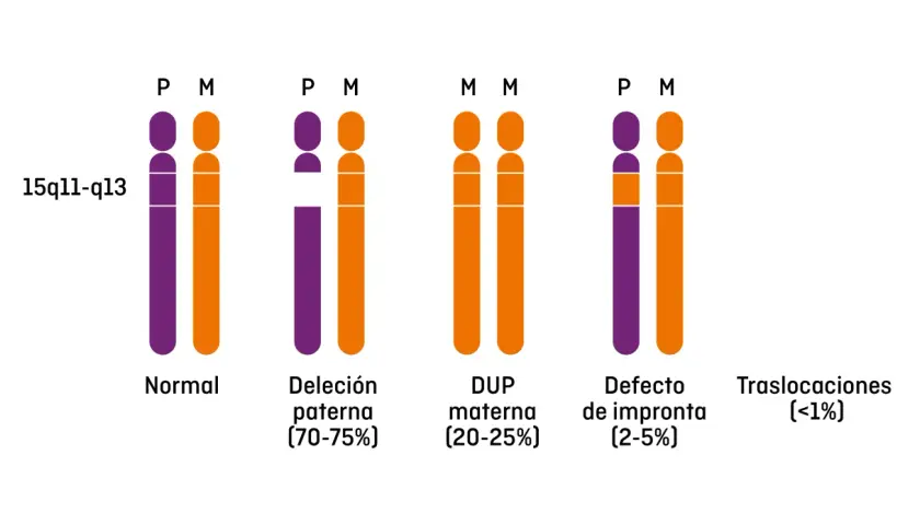 Representación de cromosomas 15q11-q13, mostrando variaciones genéticas asociadas al síndrome de Prader-Willi: normal, deleción paterna, duplicación materna, defecto de impronta y traslocaciones.