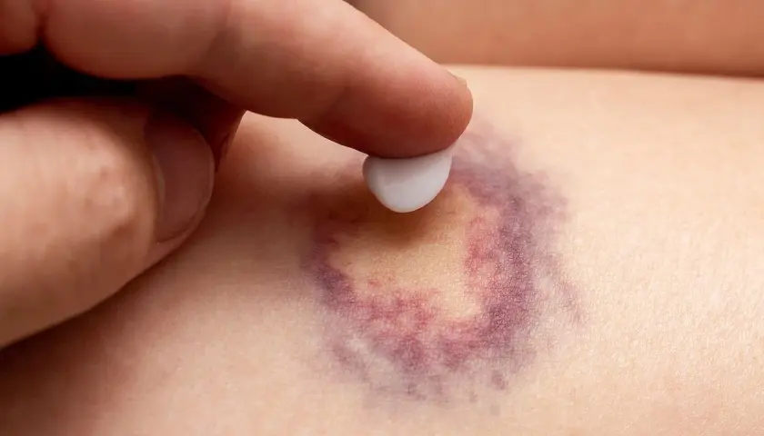 Dedo aplica crema sobre un moretón morado. Descubre cómo quitar moretones en minutos con este método.