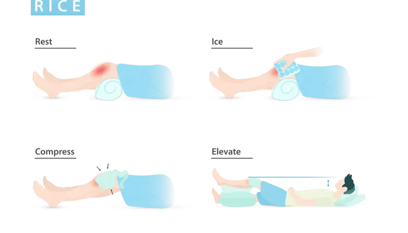 Ilustración del método RICE: reposo, hielo, compresión y elevación para tratar lesiones.