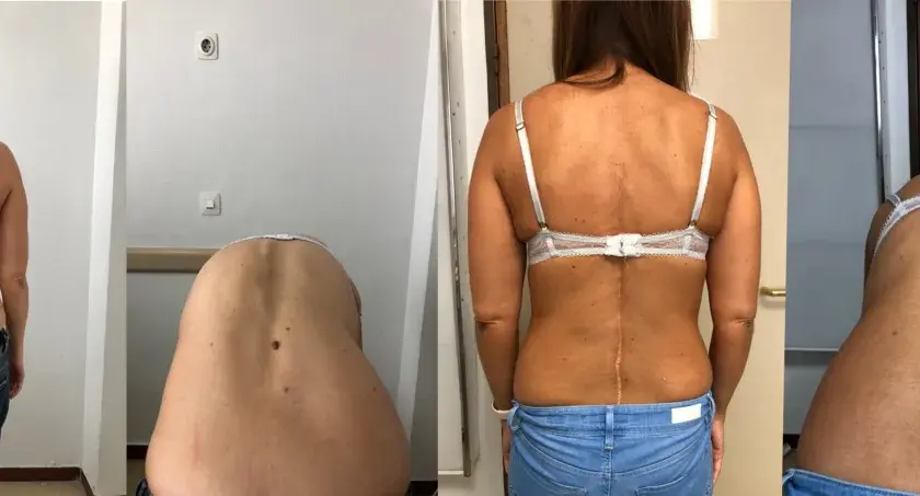Comparación de la espalda de una mujer antes y después de la corrección de escoliosis. Se puede corregir la escoliosis en adultos.