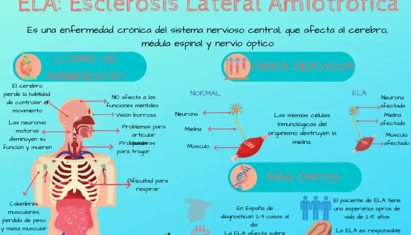 Infografía sobre la ELA, mostrando sus primeros síntomas como pérdida de control del movimiento, calambres y dificultad para respirar.