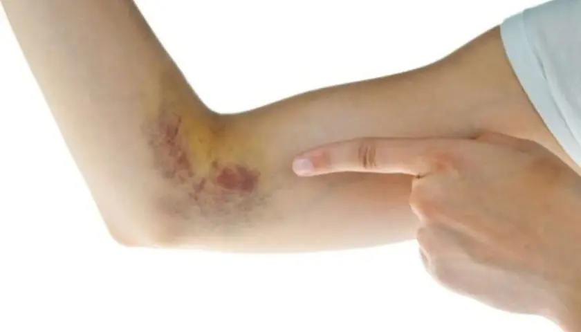 Brazo con hematoma, sangre coagulada bajo la piel como quitar.