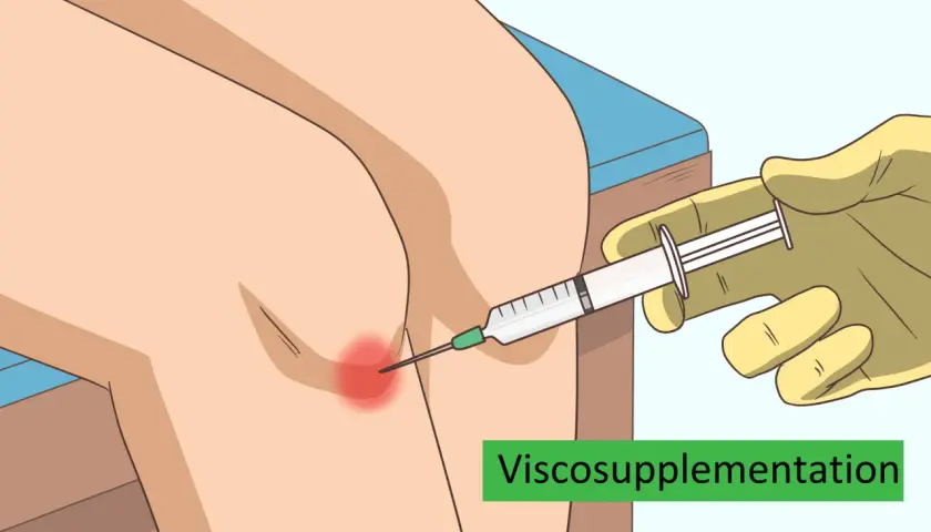 Inyección de líquido sinovial en la rodilla para aliviar el dolor.