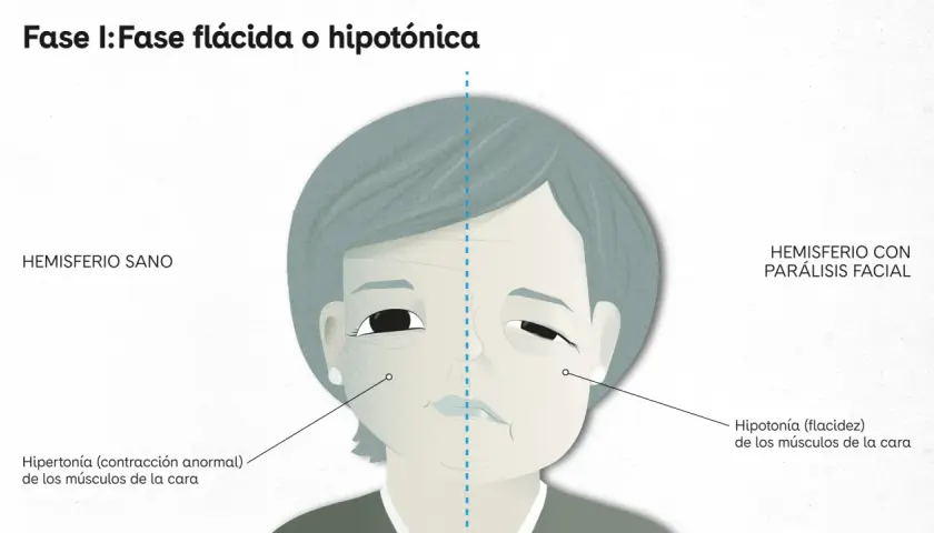 Ilustración comparativa de un rostro con parálisis facial. Un lado muestra un hemisferio sano, el otro un hemisferio con parálisis facial, con hipotonía.