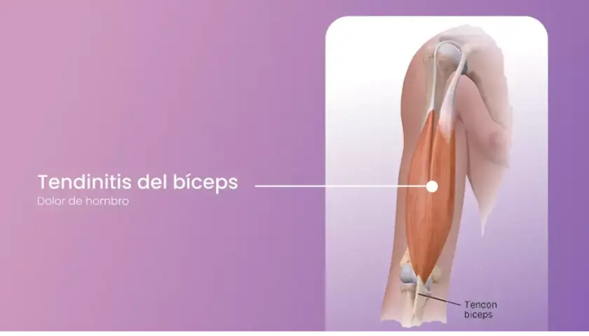 Ilustración de tendinitis del bíceps, mostrando el músculo y el tendón del bíceps.