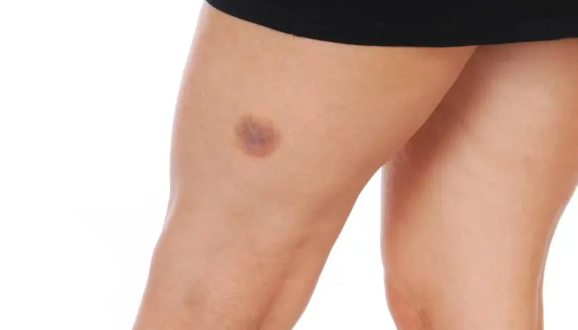 Pierna con moretones por golpes, evidencia de un impacto.
