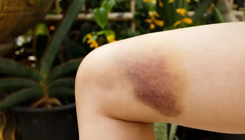 Pierna con un gran hematoma oseo, morado y amarillento, resultado de un golpe.