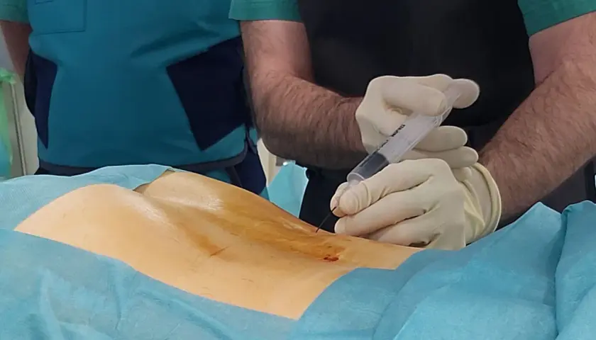 Procedimiento médico de ozonoterapia para tratar una hernia discal. Un profesional sanitario administra una inyección en la zona lumbar.