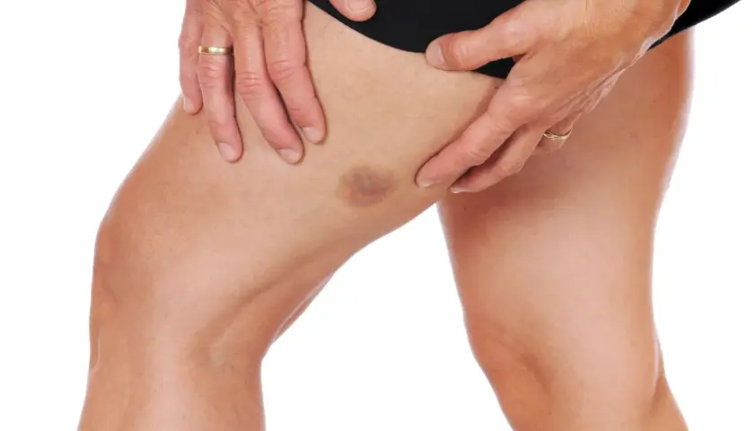 Un hematoma en el muslo, visible bajo la piel, con manos que lo sujetan suavemente.