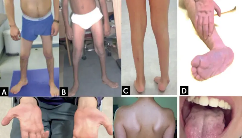 Manifestaciones de atrofia muscular espinal: piernas delgadas (A, B, C), pie equino (D), manos con dedos finos (E), espalda con escápulas prominentes (F) y lengua con fasciculaciones (G).
