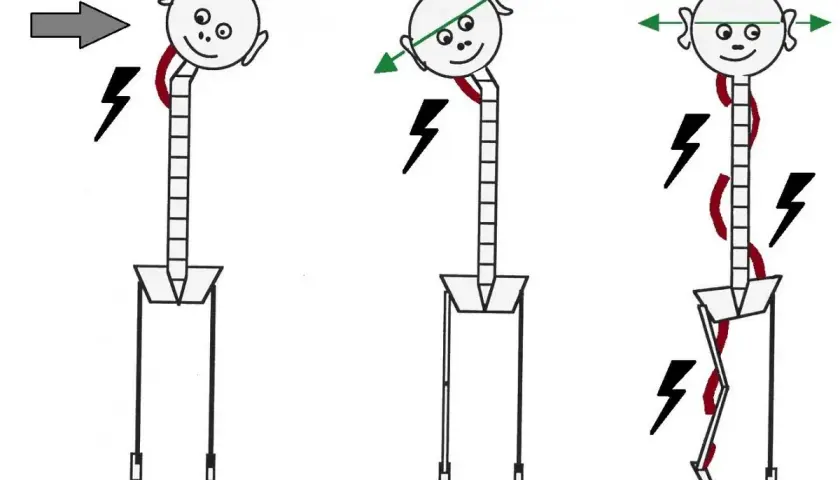 Ilustración muestra cómo un traumatismo, contractura o una cadena de tensiones musculares afectan la postura y el cuerpo.