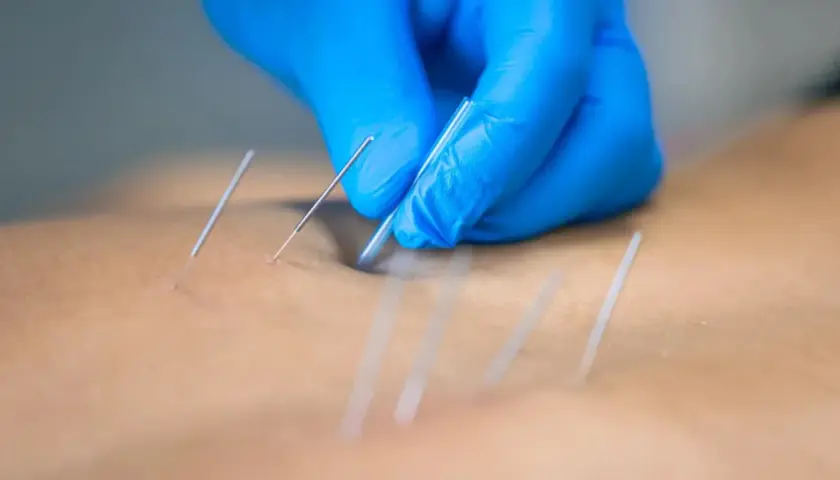 Manos enguantadas aplican agujas para punción seca, aliviando una contractura muscular.