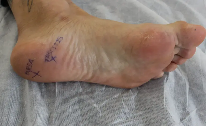 Bursitis en el pie - Síntomas, causas y tratamiento eficaz