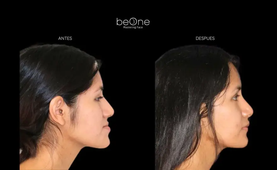 Cirugía Mandibular - Clave para una Recuperación Funcional