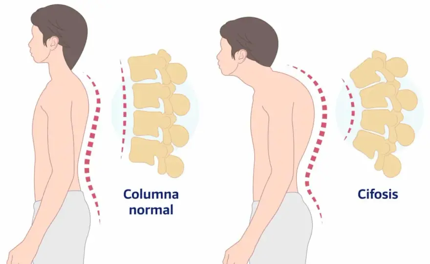 Cifosis dorsal - ¿Dolor y rigidez? Recupera tu movilidad