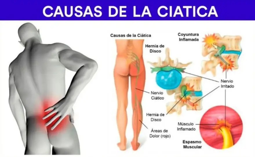 Ciática - Reconoce síntomas, causas y cuándo buscar ayuda