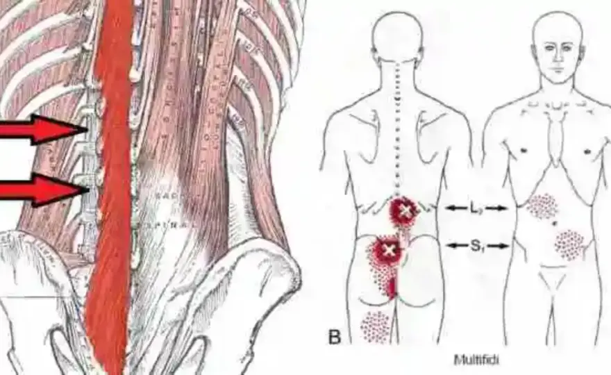 Desgarro muscular espalda - Qué hacer y cómo recuperarte