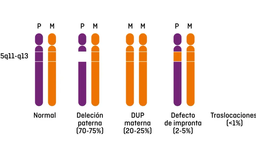 Síndrome de Prader-Willi - Guía completa para entender y actuar