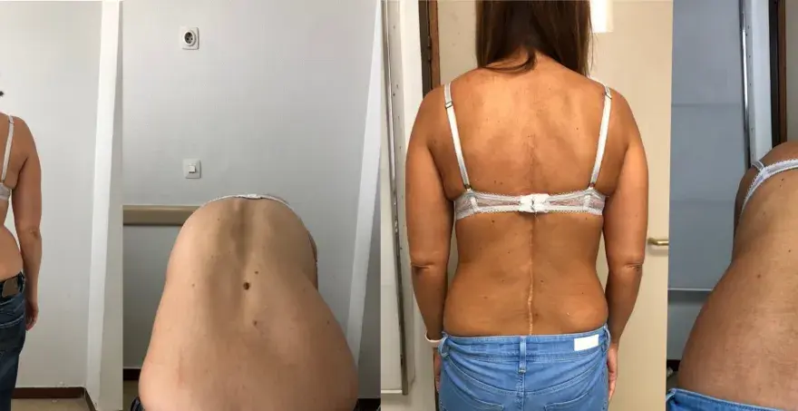 Escoliosis en adultos - ¿Se puede corregir? Guía completa
