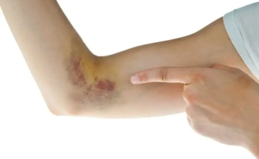 Sangre coagulada bajo la piel - Qué hacer y cuándo consultar