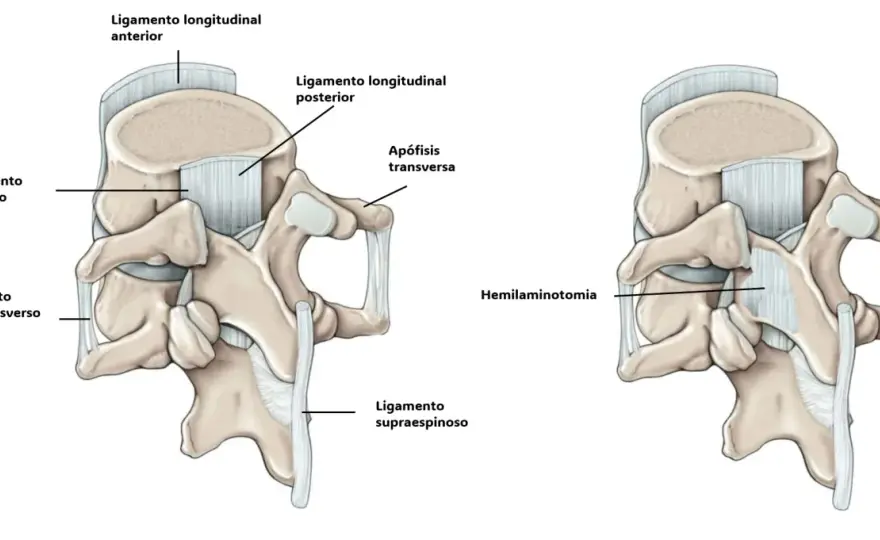 Laminectomía lumbar - ¿Cuándo es la solución real?
