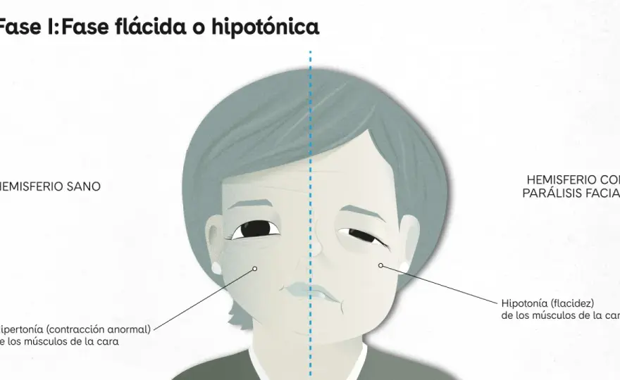 Parálisis facial - ¿ictus o Bell? Señales y acción urgente