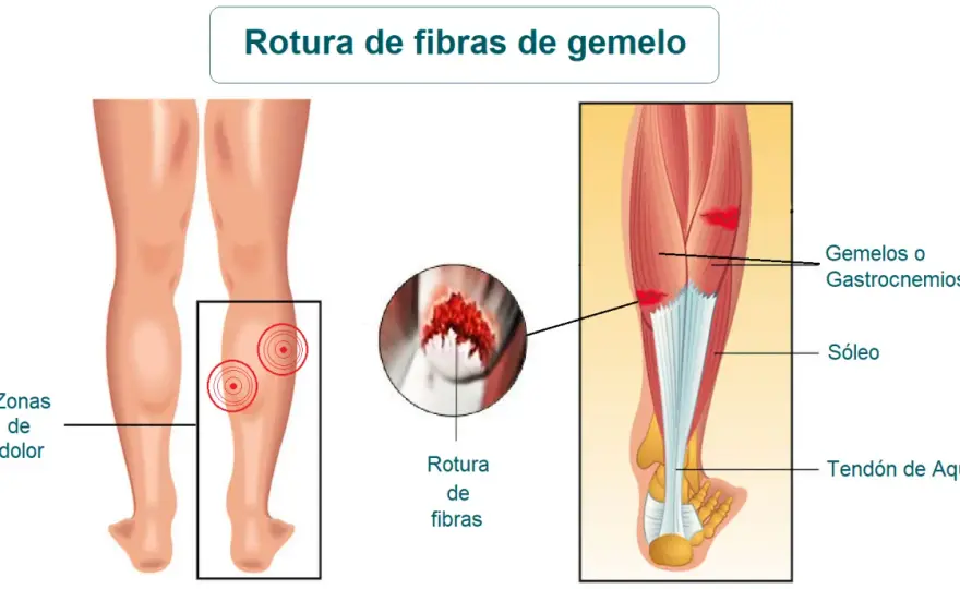 Fibras del gemelo: ¿Por qué no es solo un músculo?