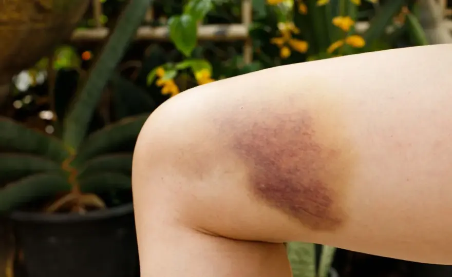 Hematoma óseo - ¿Qué es y cómo recuperarse bien?