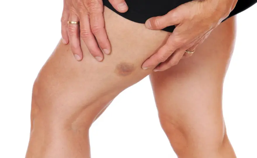 Hematoma en el muslo - Qué hacer y cuándo buscar ayuda