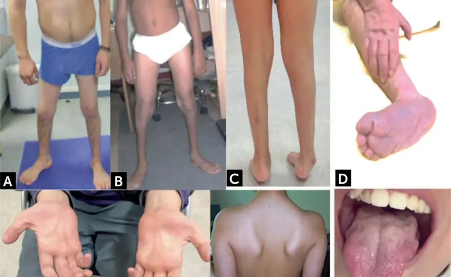 Atrofia muscular espinal - Guía completa y fisioterapia clave
