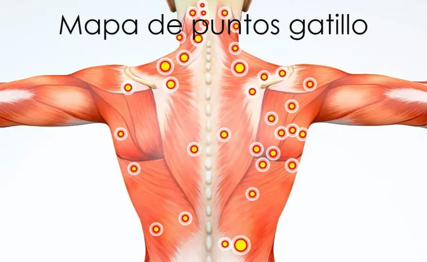 Puntos gatillo - ¿Por qué duele siempre en el mismo sitio?