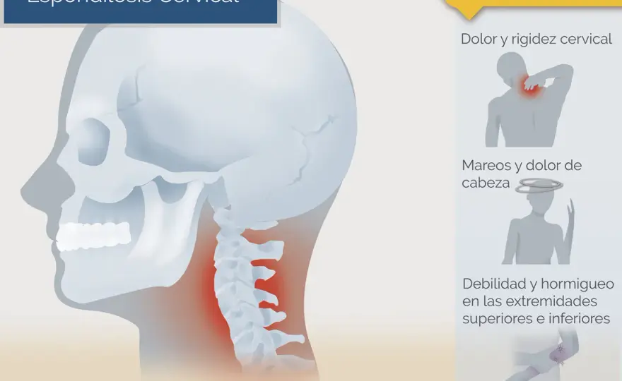 Espondilosis cervical - ¿Desgaste o algo más? Guía completa