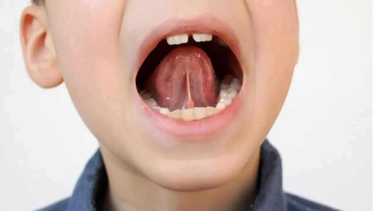 Boca abierta de un niño mostrando la lengua y el frenillo.