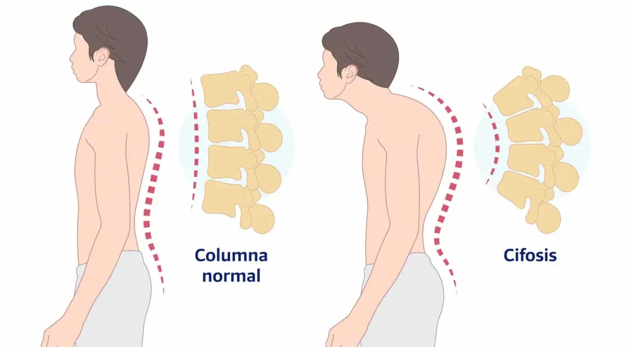 Comparación de columna normal y cifosis dorsal. La imagen muestra la curvatura de la espalda y la columna vertebral en dos posturas.