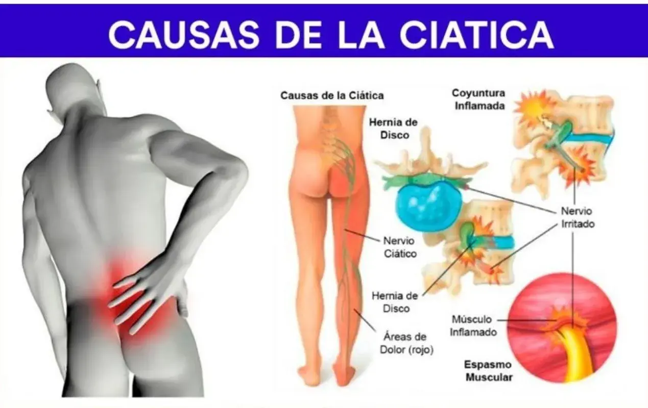 Ilustración muestra las causas de la ciática: hernia de disco, nervio ciático irritado y espasmo muscular, explicando los síntomas.