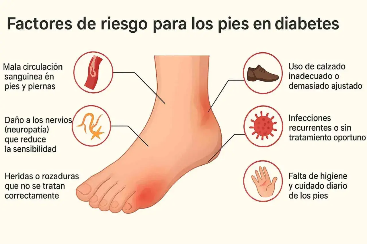 Factores de riesgo para pies diabéticos: mala circulación, neuropatía, heridas, calzado inadecuado, infecciones y falta de higiene.